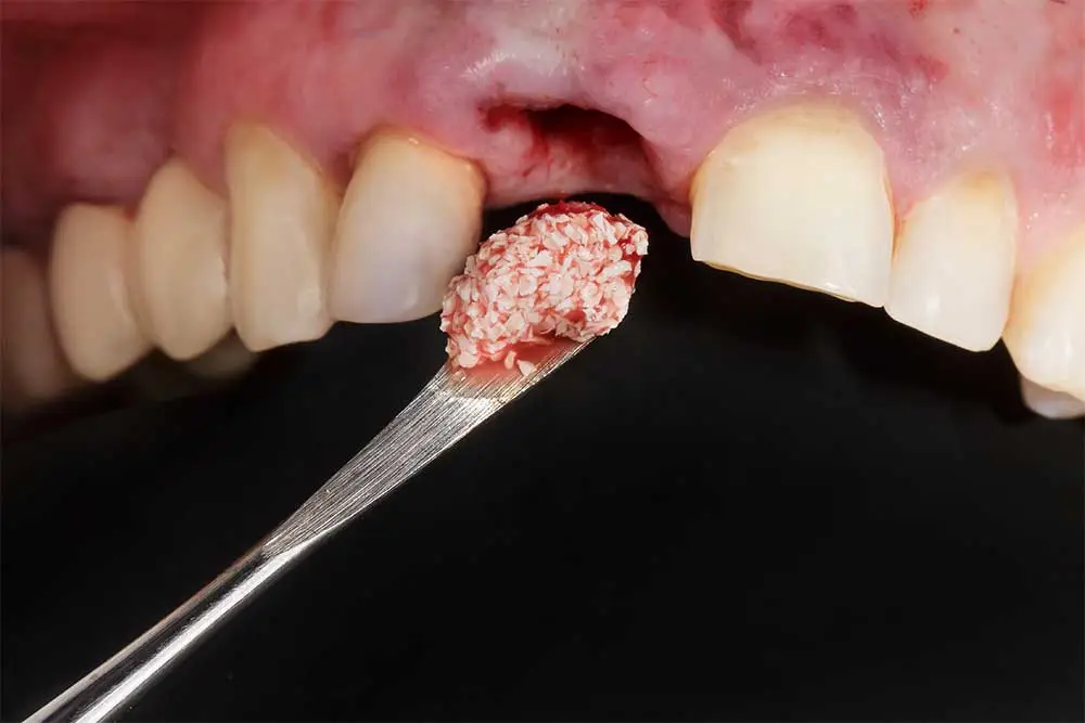 Bone grafting