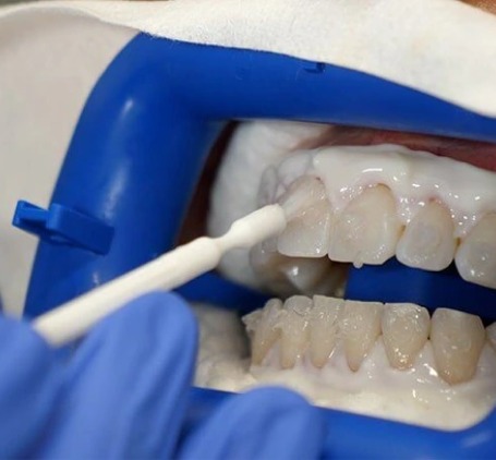 How do Teeth whitening work?