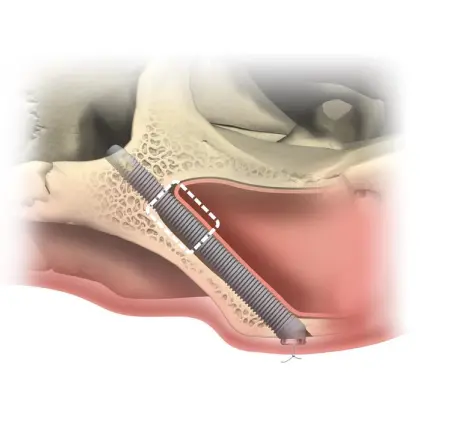 Zygomatic implants