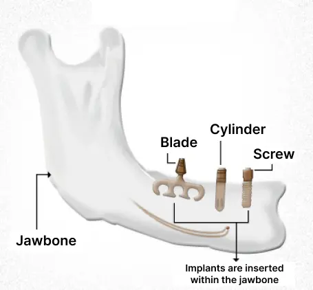 Endosteal implants