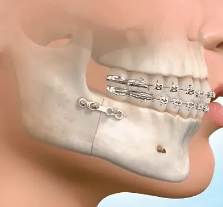 Jaw correction surgery