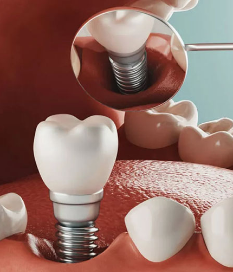 Dental implants