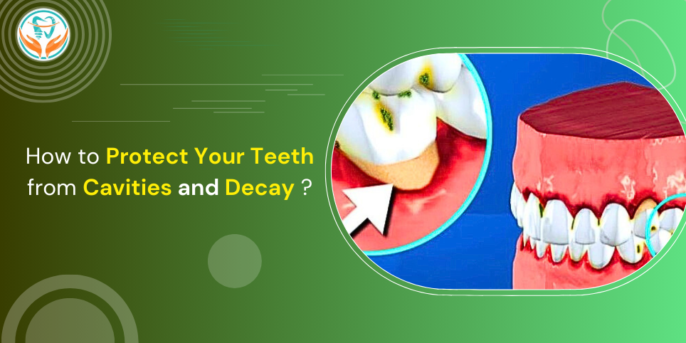 How to Protect Your Teeth from Cavities and Decay